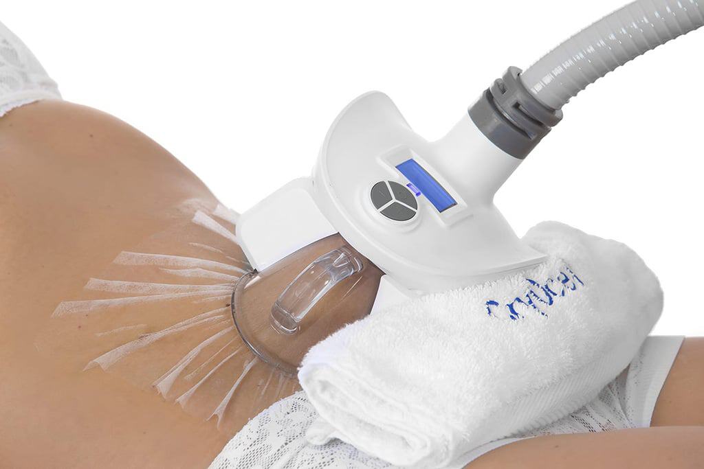 Cryolipolyse avant l'été
